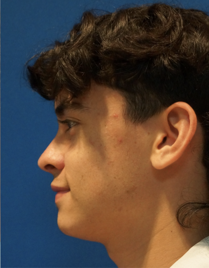 Case--1182 | After Rhinoplasty 3