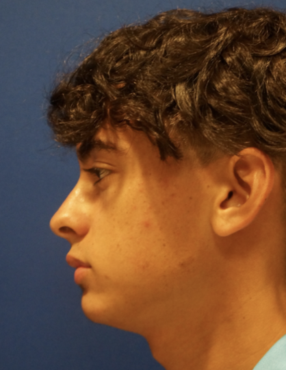 Case--1182 | Before Rhinoplasty 3