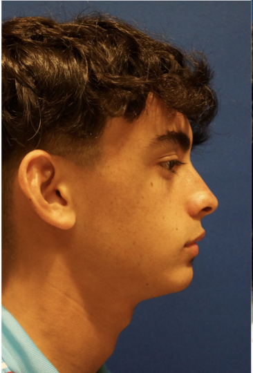 Case--1182 | Before Rhinoplasty 4