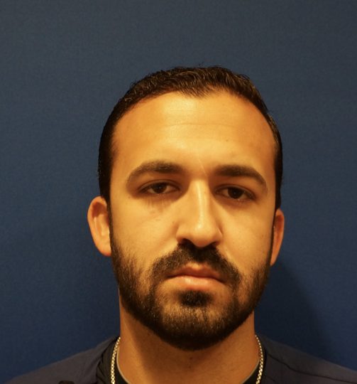 Case--7213 | Before Rhinoplasty