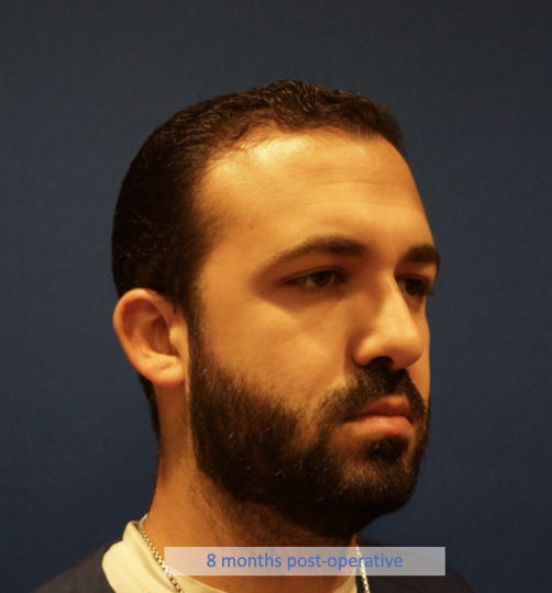 Case--7213 | After Rhinoplasty 5