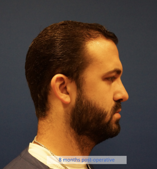 Case--7213 | After Rhinoplasty 6