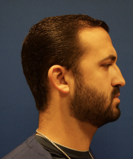 Case--7213 | Before Rhinoplasty 6