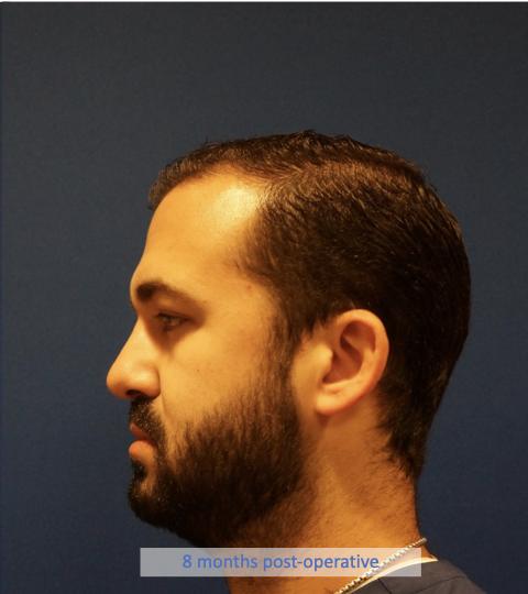 Case--7213 | After Rhinoplasty 4