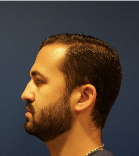 Case--7213 | Before Rhinoplasty 4