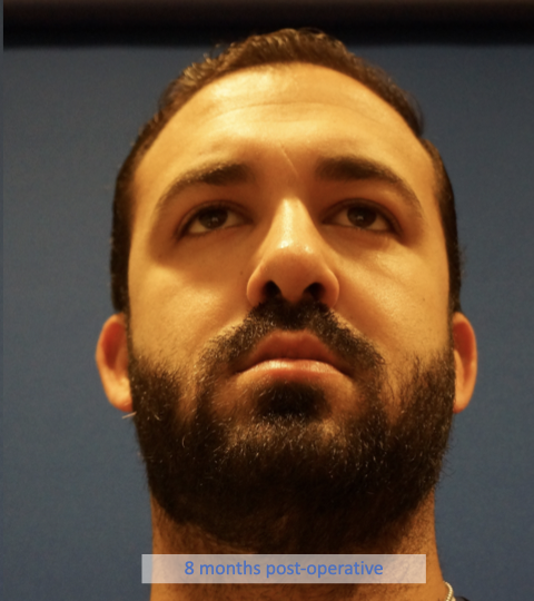 Case--7213 | After Rhinoplasty 7