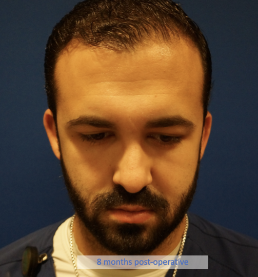 Case--7213 | After Rhinoplasty 2