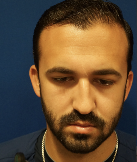 Case--7213 | Before Rhinoplasty 2