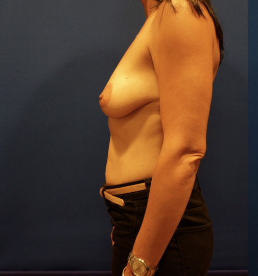 Case--3836 | Before Tummy Tuck 3