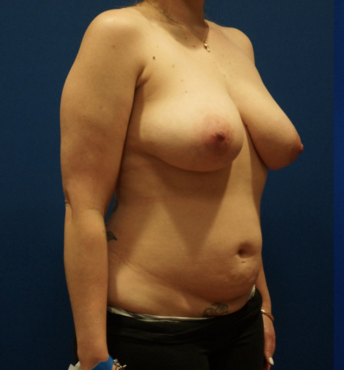 Case--3722 | Before Mommy Makeover 4