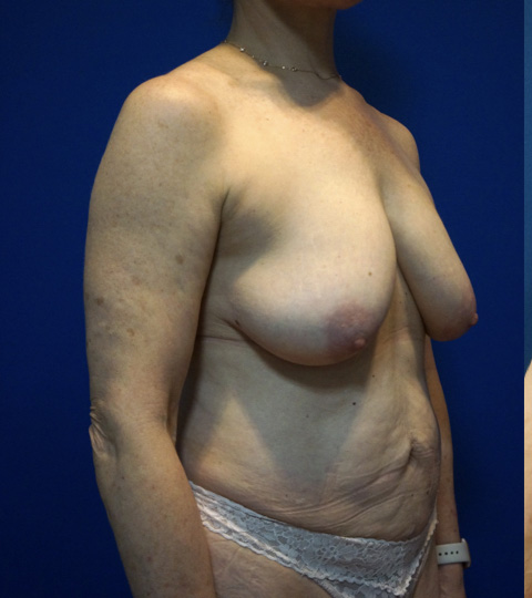 Case--5131 | Before Mommy Makeover 2