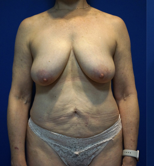 Case--5131 | Before Mommy Makeover 6