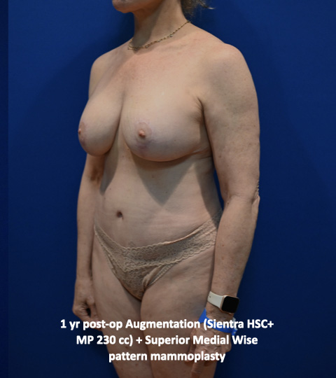 Case--5131 | After Mommy Makeover 9