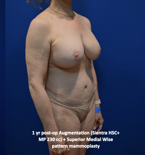 Case--5131 | After Mommy Makeover 7