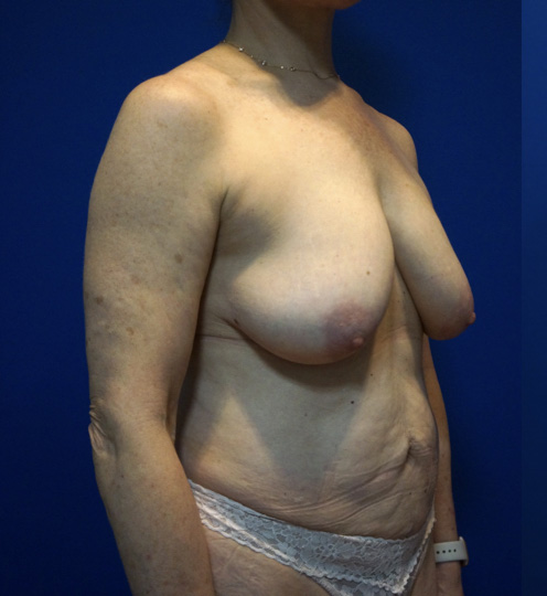 Case--5131 | Before Mommy Makeover 7