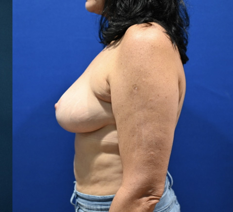 Case--4897 | After Breast Reduction 3