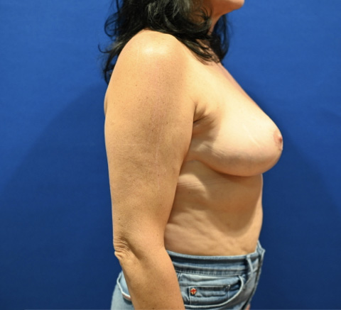 Case--4897 | After Breast Reduction 5