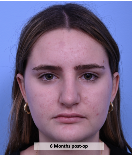Case--2372 | After Rhinoplasty