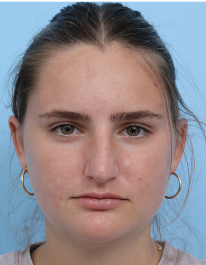 Case--2372 | Before Rhinoplasty