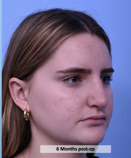 Case--2372 | After Rhinoplasty 2
