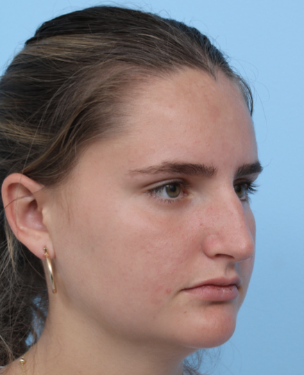Case--2372 | Before Rhinoplasty 2