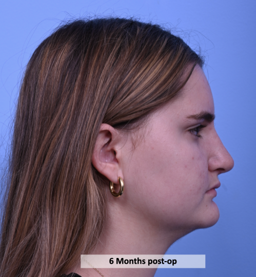 Case--2372 | After Rhinoplasty 3