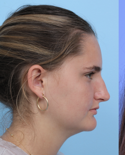 Case--2372 | Before Rhinoplasty 3