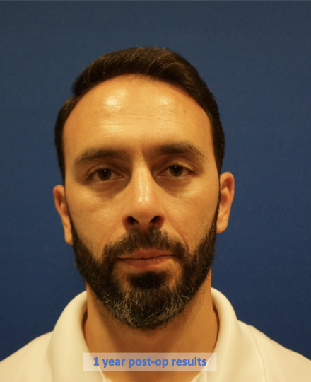 Case--9527 | After Rhinoplasty