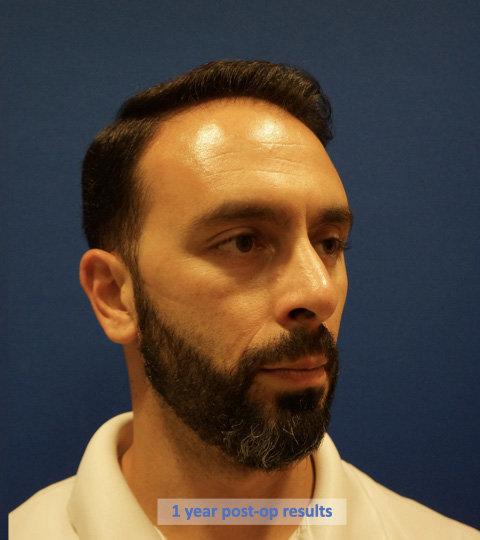 Case--9527 | After Rhinoplasty 2