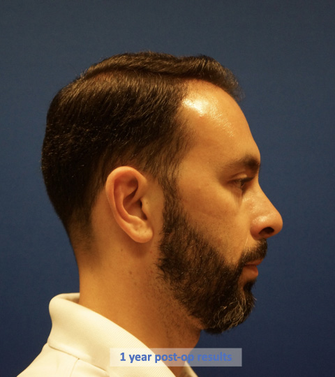 Case--9527 | After Rhinoplasty 3