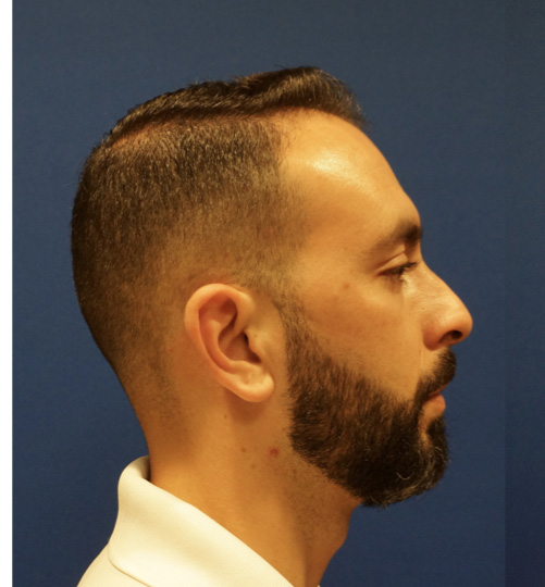 Case--9527 | Before Rhinoplasty 3