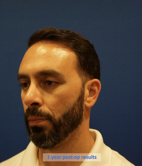 Case--9527 | After Rhinoplasty 4