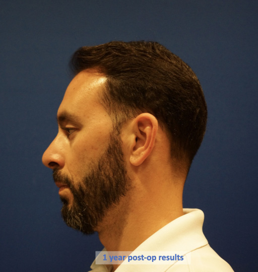 Case--9527 | After Rhinoplasty 5