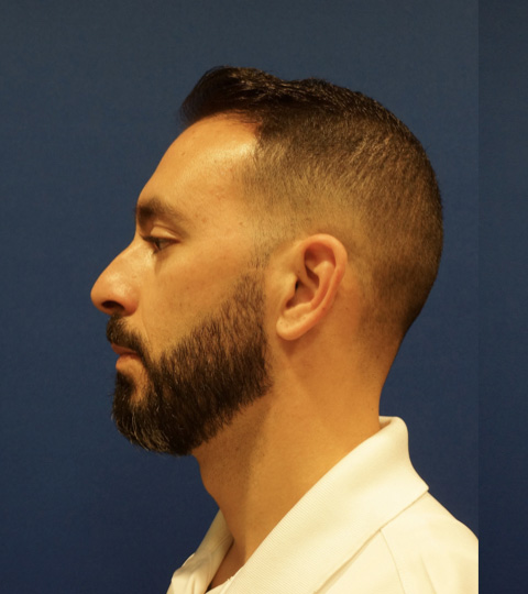Case--9527 | Before Rhinoplasty 5