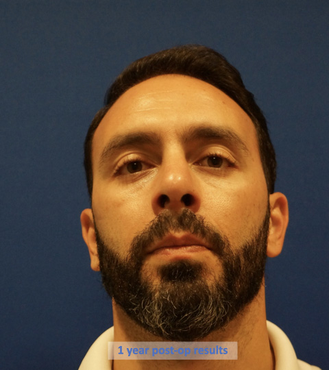 Case--9527 | After Rhinoplasty 6