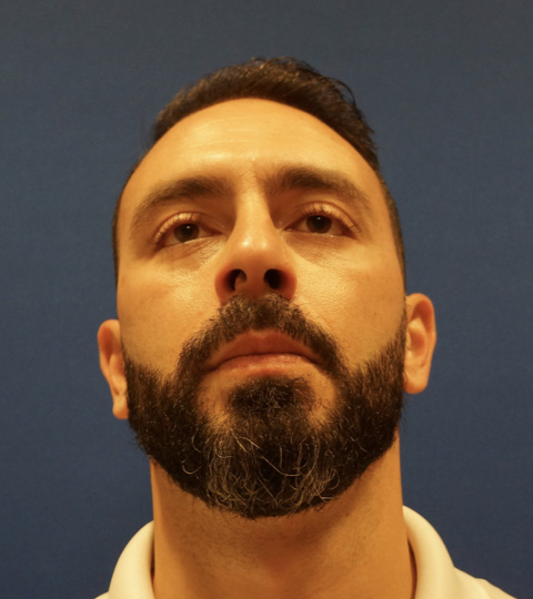Case--9527 | Before Rhinoplasty 6
