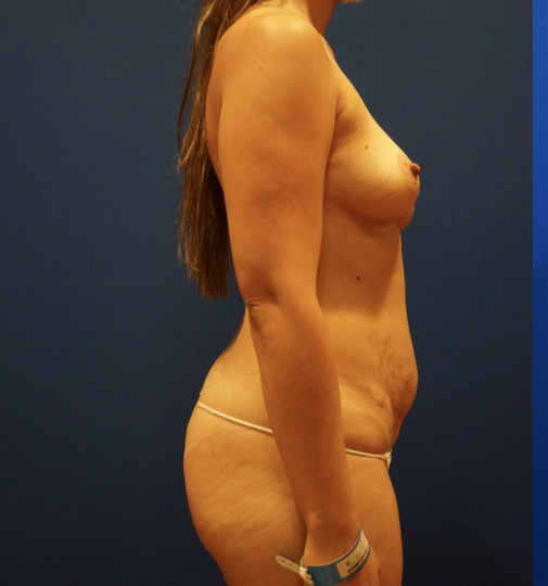 Case--7787 | Before Tummy Tuck 3