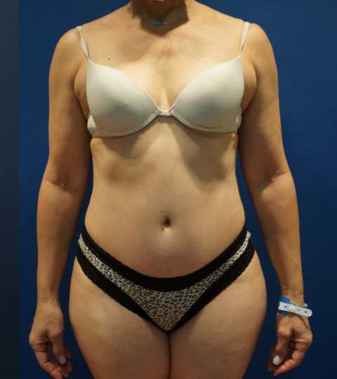 Case--3744 | After Tummy Tuck