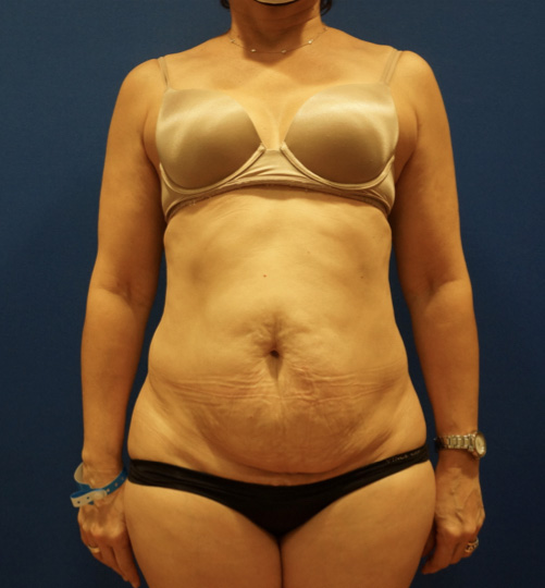 Case--3744 | Before Tummy Tuck