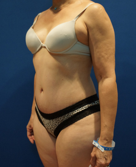 Case--3744 | After Tummy Tuck 2