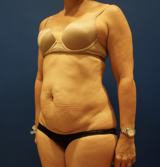 Case--3744 | Before Tummy Tuck 2