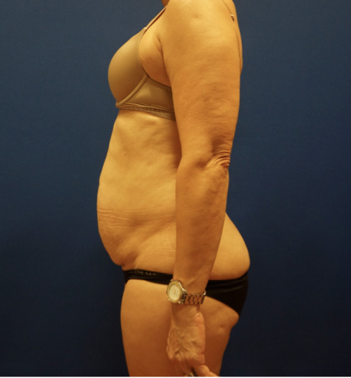 Case--3744 | Before Tummy Tuck 3