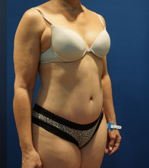 Case--3744 | After Tummy Tuck 4