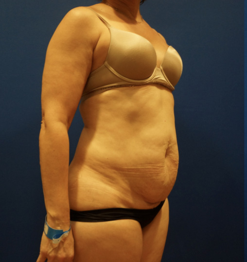 Case--3744 | Before Tummy Tuck 4