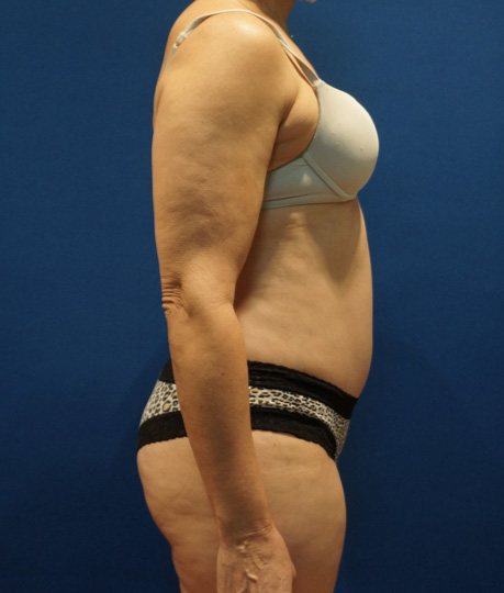 Case--3744 | After Tummy Tuck 5
