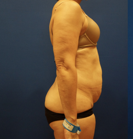 Case--3744 | Before Tummy Tuck 5