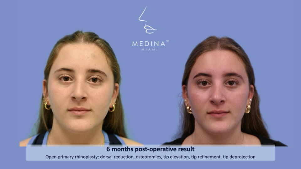 Case--2310 | Before and After Rhinoplasty