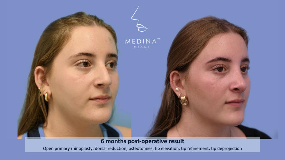 Case--2310 | Before and After Rhinoplasty 2