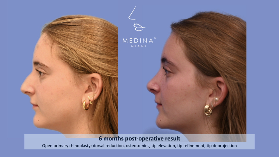 Case--2310 | Before and After Rhinoplasty 3