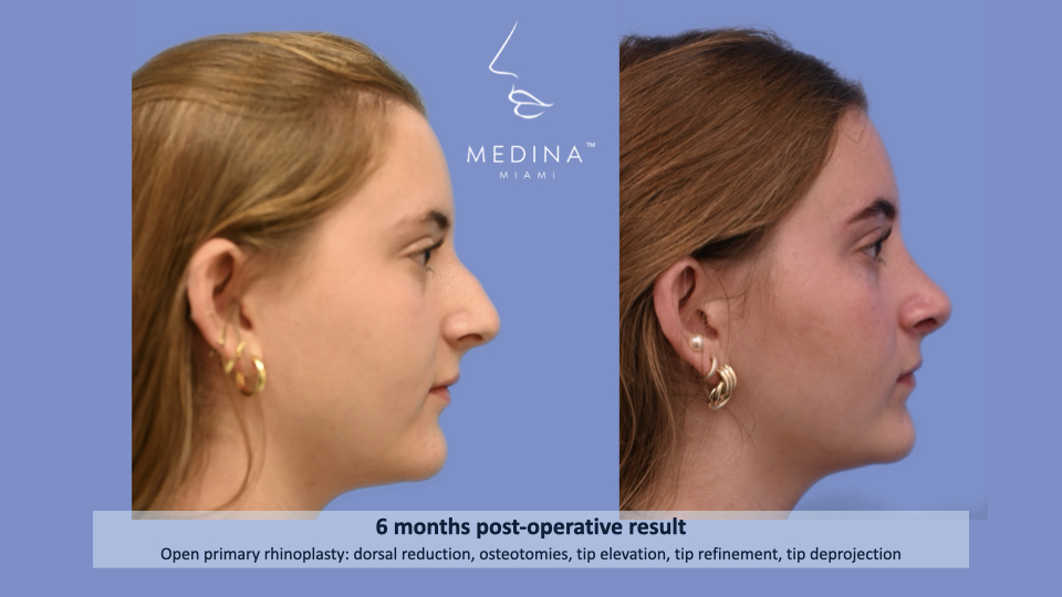 Case--2310 | Before and After Rhinoplasty 4